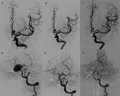 Tubridge flow diverter alone vs. Tubridge flow diverter and coils for the treatment of intracranial aneurysms: A propensity score matching analysis